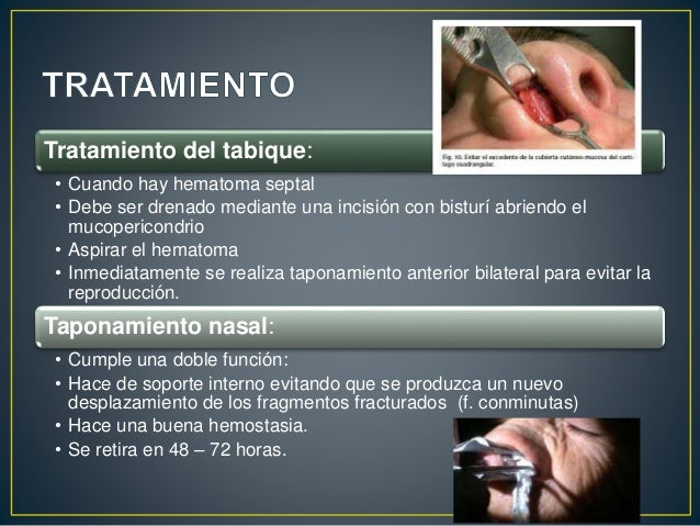 Fractura nasal Fractura nasal