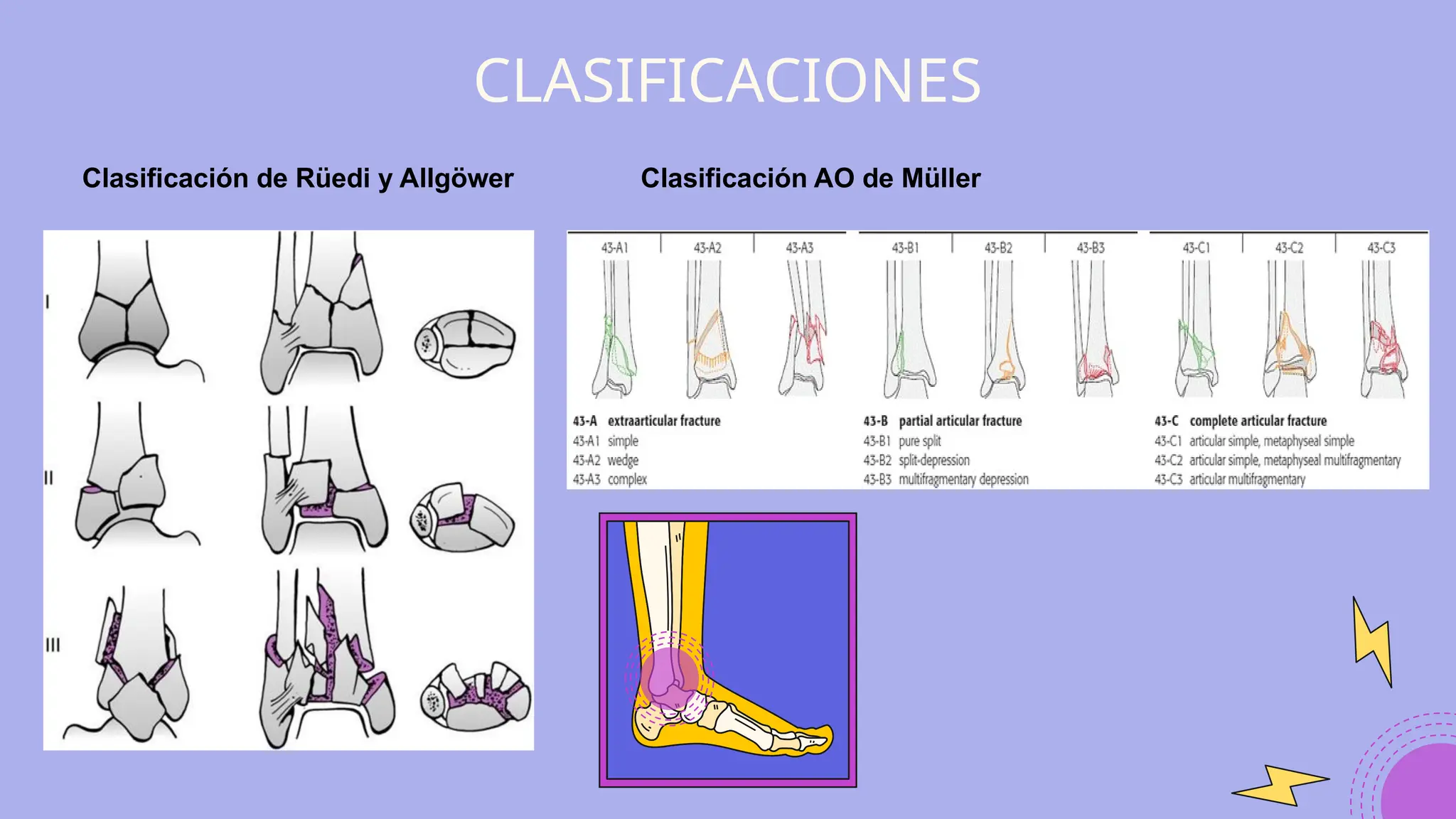 FRACTURA PILON DE TIBIA Universidad de Guayaquil.pptx