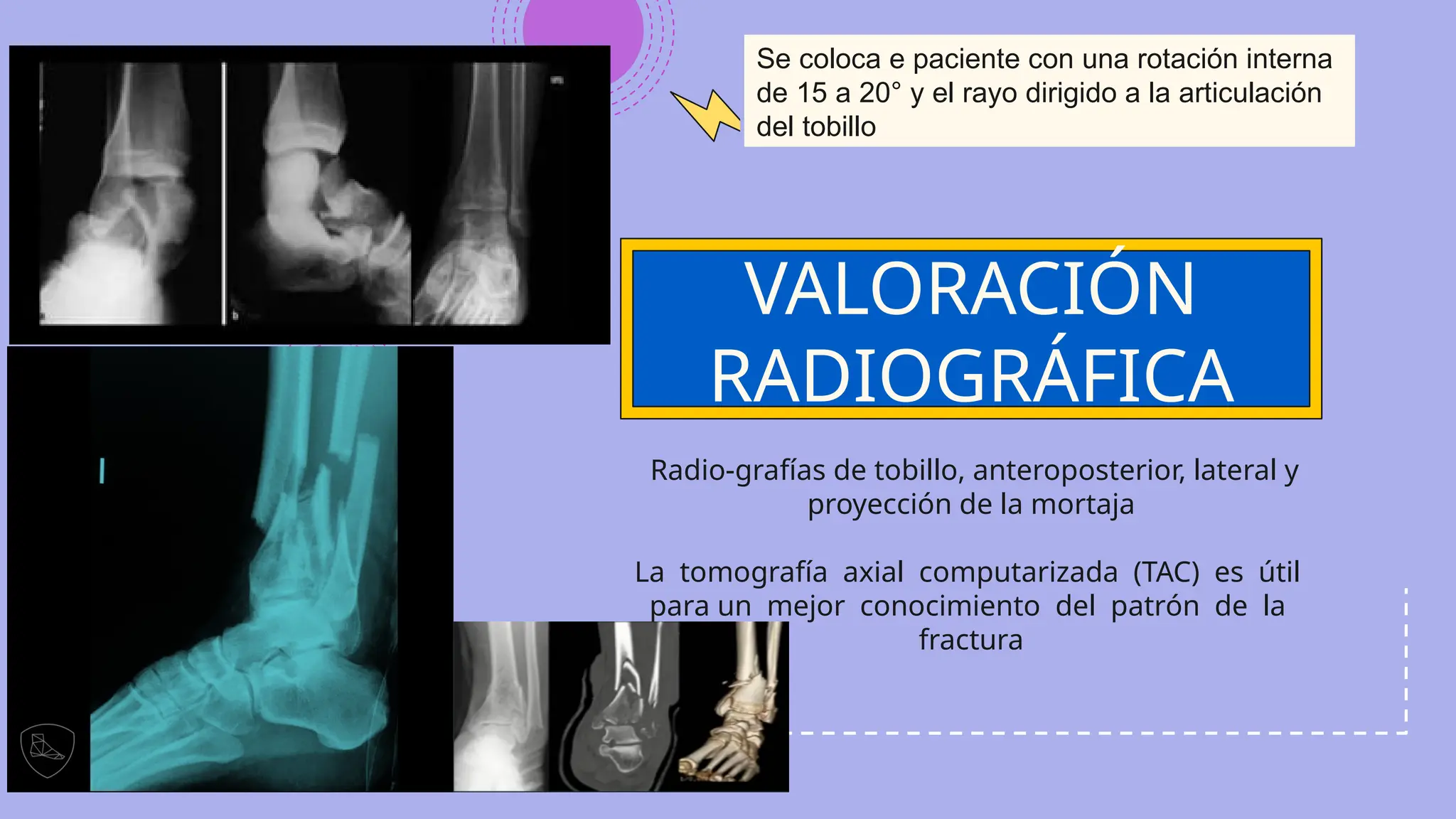 FRACTURA PILON DE TIBIA Universidad de Guayaquil.pptx