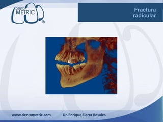 www.dentometric.com Dr. Enrique Sierra Rosales
Fractura
radicular
 