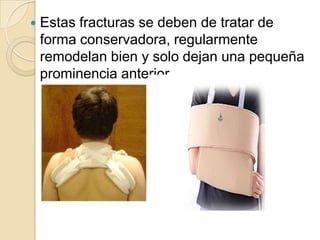 Fractura del tercio proximalLa fractura del tercio proximal son difíciles de diagnosticar y se confunden con luxaciones anteriores de la articulación esternoclavicular y con fracturas grado I y II de Salter-HarrisHabitualmente aparece un bulto  2 semanas después del accidente  en el extremo medial.