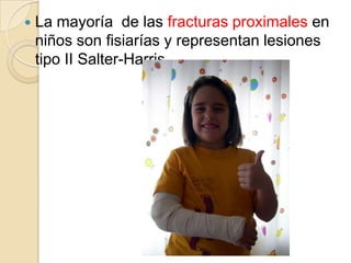 Fracturas de la diafisis y del extremo proximal del humero.Las fracturas de la porción media del humero en niños, siempre consolidan. Cuando  se tratan con escayola de brazo colgante, resultan mínimos el acortamiento, la angulacion y la deformidad.