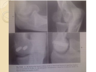 FRACTUTAS DEL CAPITELLUMTipo II: suelen ser cartilaginosas y pueden incluir un pequeño fragmento de hueso subcondral.Tipo III: son fracturas conminutas.Tx: Reducción cerrada, abierta y fijación interna y la extirpación del fragmento.