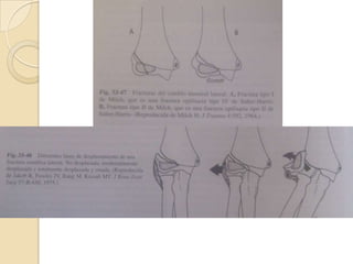 FRACTURAS DEL CÓNDILO LATERALFractura epifisaria distal mas frecuente.Tipo I: la línea de fractura se localiza en posición medial a la tróclea, a través y dentro del surco epicóndilo-troclear.Tipo II: es mas frecuente, la línea de fractura se extiende en el área de la tróclea y produce inestabilidad intrínseca del codo. 