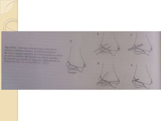 FRACTURAS DEL CÓNDILO LATERALLa reducción abierta y la fijación interna resultan necesarias para las fracturas desplazadas.Fracturas condíleas laterales del humero distal con menos de 2mm de desplazamiento se procede a reducción cerrada y enclavadas percutáneamente con ayuda del intensificador de imágenes.