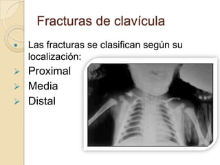 Fracturas de clavículaLas fracturas se clasifican según su localización:Proximal 