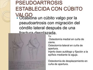 FRACTURAS DEL CÓNDILO LATERALSe ha descrito la reducción abierta y la fijación interna con injerto ósea para la pseudoartrosis establecida del cóndilo lateral.El miembro se inmoviliza en una escayola con el codo a 90 grados de flexión y antebrazo en rotación neutra durante 12 semanas.Quitar aguja e iniciar los ejercicios activos.