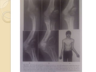 PSEUDOARTROSIS ESTABLECIDA CON CÚBITO VALGOOcasiona un cúbito valgo por la pseudoartrosis con migración del cóndilo lateral después de una fractura desplazada.Tx:Osteotomía medial en cuña de cierre.Osteotomía lateral en cuña de apertura.Injerto óseo autólogo y fijación a la epífisis mediante la aguja.Osteotomía de desplazamiento en cuña de apertura.