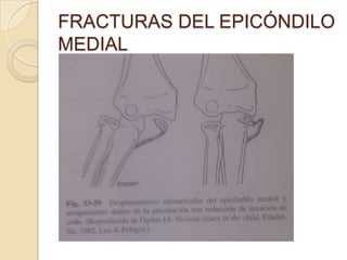 FRACTURAS DEL EPICÓNDILO MEDIALIndicaciones para reducción abierta:Rotación y desplazamiento superior a 1 cm.Atrapamiento persistente de fragmentos en la articulación.Disfunción del nervio cubital.Inestabilidad en valgo 
