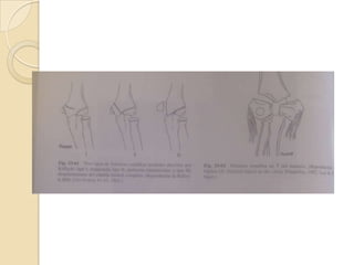 FRACTURAS DEL CÓNDILO MEDIALSon de las lesiones menos frecuentes del codo.Tipo I: impacta o en tallo verde.Tipo II: a través del cóndilo humeral en la articulación con desplazamiento escaso o nulo.Tipo III: una fractura epifisaria que es intraarticular y que afecta al cóndilo medial con el fragmento desplazado y rotado.
