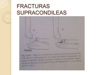 FRACTURAS SUPRACONDILEASTipo I: sin desplazamiento.Tx: reducción cerrada y fijación externa.Tipo II: desplazadas y difícil de reducir con métodos externos.Tipo III: desplazamiento posteromedial y posterolateralsin contacto cortical y periostio arrancado. La reducción es difícil sin alguna forma de reducción interna.