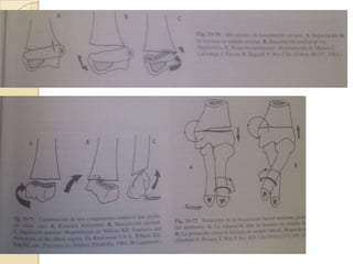 FRACTURAS SUPRACONDILEAS