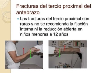 Reducción cerrada y enclavamiento percutáneo