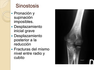 Fracturas del tercio proximal del antebrazoLas fracturas del tercio proximal son raras y no se recomienda la fijación interna ni la reducción abierta en niños menores a 12 años