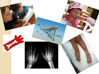 Desplazamiento inicial grave