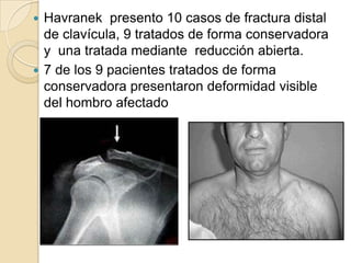 DistalFractura del tercio distalLas fracturas del tercio distal consolidan satisfactoriamente sin tratamiento quirúrgico, debido a que la envoltura periostica permanece intacta en el foco de la fractura, permitiendo la remodelación ósea dentro de la capsula