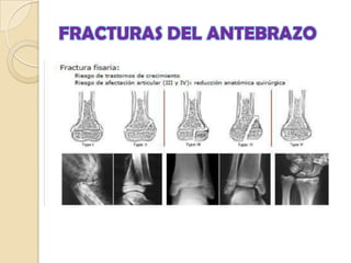 FRACTURAS DEL ANTEBRAZOFracturas en tallo verde: el grosor perióstico y la elasticidad del hueso de los niños produce rotura de sólo una de las corticales del hueso, en el lado de máxima convexidad.