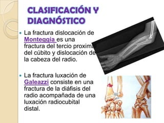 FRACTURAS DEL ANTEBRAZOHistóricamente el estándar para tratar la mayoría de estas fracturas en los niños ha sido por reducción cerrada e inmovilización con yesoPRONACIÓNPOSICION NEUTRASUPINACIÓN