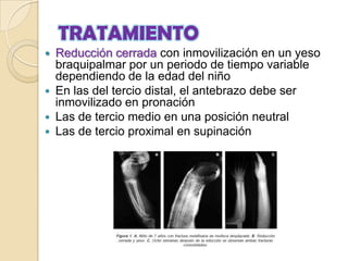CLASIFICACIÓN Y DIAGNÓSTICOLa fractura dislocación deMonteggiaes una fractura del tercio proximal del cúbito y dislocación de la cabeza del radio.La fractura luxación de Galeazzi consiste en una fractura de la diáfisis del radio acompañada de una luxación radiocubital distal.