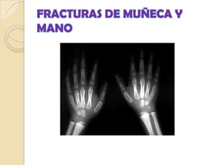 DIAGNÓSTICOEl diagnóstico clínico se hace con la presencia de aumento de volumen, deformidad y dolor.La piel se inspecciona cuidadosamente para detectar exposición Se realiza una exploración vascular y neurológica para descartar síndrome compartimentalSe examinan las articulaciones proximal y distal