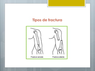 Tipos de fractura
 