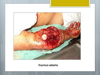 Fractura abierta
 