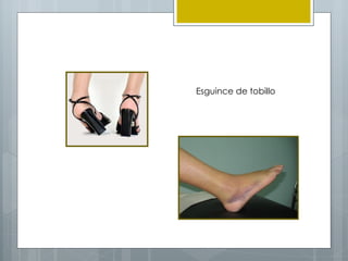 Esguince de tobillo
 