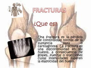 ¿Que es?

 Una fractura es la pérdida
 de continuidad normal de la
 sustancia        ósea       o
 cartilaginosa. La fractura es
 una discontinuidad en los
 huesos, a consecuencia de
 golpes, fuerzas o tracciones
 cuyas intensidades superen
 la elasticidad del hueso.
 