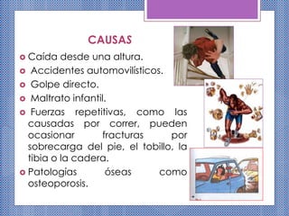 CAUSAS
 Caída desde una altura.
 Accidentes automovilísticos.
 Golpe directo.
 Maltrato infantil.
 Fuerzas repetitivas, como las
causadas por correr, pueden
ocasionar fracturas por
sobrecarga del pie, el tobillo, la
tibia o la cadera.
 Patologías óseas como
osteoporosis.
 