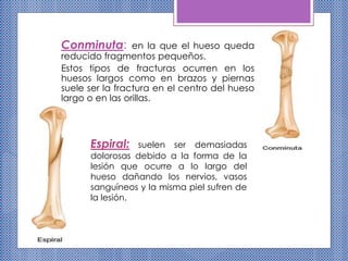 Conminuta: en la que el hueso queda
reducido fragmentos pequeños.
Estos tipos de fracturas ocurren en los
huesos largos como en brazos y piernas
suele ser la fractura en el centro del hueso
largo o en las orillas.
Espiral: suelen ser demasiadas
dolorosas debido a la forma de la
lesión que ocurre a lo largo del
hueso dañando los nervios, vasos
sanguíneos y la misma piel sufren de
la lesión.
 