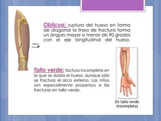 Oblicua: ruptura del hueso en forma
de diagonal la línea de fractura forma
un ángulo mayor o menor de 90 grados
con el eje longitudinal del hueso.
Tallo verde: factura incompleta en
la que se dobla el hueso, aunque sólo
se fractura el arco externo. Los niños
son especialmente propensos a las
fracturas en tallo verde.
 