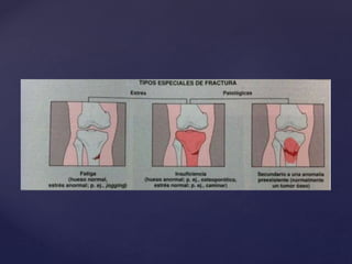 Radiología - Fracturas