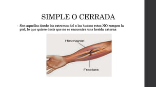 SIMPLE O CERRADA
• Son aquellos donde los extremos del o los huesos rotos NO rompen la
piel, lo que quiere decir que no se encuentra una herida externa
 
