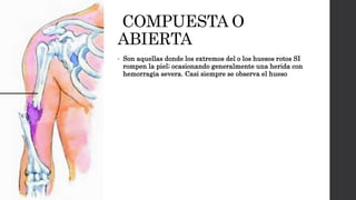 COMPUESTA O
ABIERTA
• Son aquellas donde los extremos del o los huesos rotos SI
rompen la piel; ocasionando generalmente una herida con
hemorragia severa. Casi siempre se observa el hueso
 