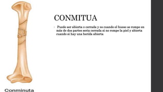 CONMITUA
• Puede ser abierta o cerrada y es cuando el hueso se rompe en
más de dos partes seria cerrada si no rompe la piel y abierta
cuando si hay una herida abierta
 