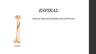 ESPIRAL
 fractura dispuesta alrededor del eje del hueso
 