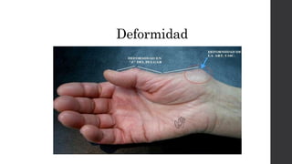 Deformidad
 