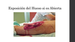 Exposición del Hueso si es Abierta
 