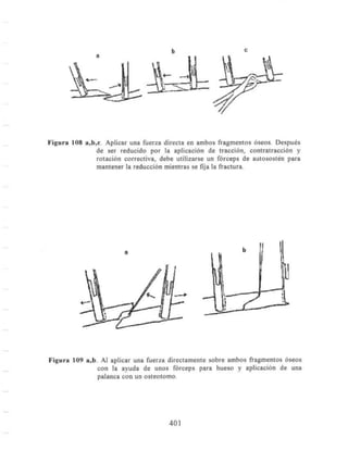 Fracturas