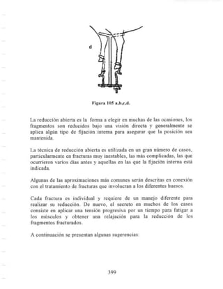 Fracturas
