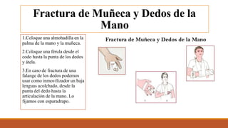 Fractura de Muñeca y Dedos de la
Mano
1.Coloque una almohadilla en la
palma de la mano y la muñeca.
2.Coloque una férula desde el
codo hasta la punta de los dedos
y átela.
3.En caso de fractura de una
falange de los dedos podemos
usar como inmovilizador un baja
lenguas acolchado, desde la
punta del dedo hasta la
articulación de la mano. Lo
fijamos con esparadrapo.
 