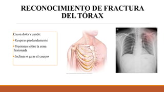 RECONOCIMIENTO DE FRACTURA
DELTÓRAX
Causa dolor cuando:
Respiras profundamente
Presionas sobre la zona
lesionada
Inclinas o giras el cuerpo
 