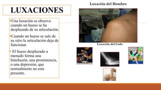 LUXACIONES
Una luxación se observa
cuando un hueso se ha
desplazado de su articulación.
Cuando un hueso se sale de
su sitio la articulación deja de
funcionar.
 El hueso desplazado a
menudo forma una
hinchazón, una prominencia,
o una depresión, que
normalmente no esta
presente.
 