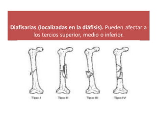 Diafisarias (localizadas en la diáfisis). Pueden afectar a
los tercios superior, medio o inferior.
 