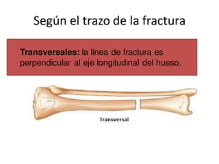 Según el trazo de la fractura
Transversales: la línea de fractura es
perpendicular al eje longitudinal del hueso.
 