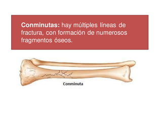 Conminutas: hay múltiples líneas de
fractura, con formación de numerosos
fragmentos óseos.
 
