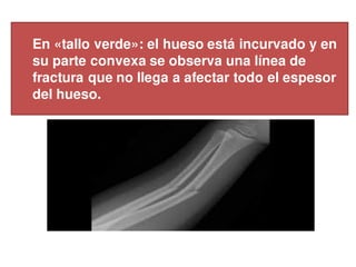 En «tallo verde»: el hueso está incurvado y en
su parte convexa se observa una línea de
fractura que no llega a afectar todo el espesor
del hueso.
 
