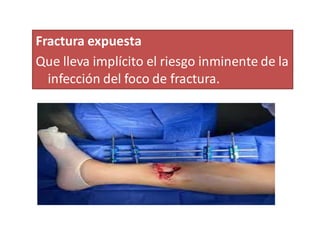 Fractura expuesta
Que lleva implícito el riesgo inminente de la
infección del foco de fractura.
 