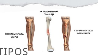 Cuidados de enfermería en fracturas expuesta, mixta, fragmentada.pptx