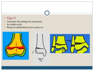 Tipo V Contusión del cartílago de crecimiento No visible en Rx Riesgo de epifisiodesis  (fusión epifisiaria) 